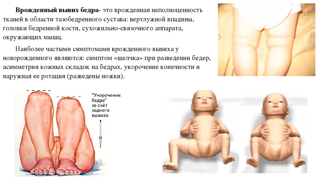 Врождённый вывих бедра, дисплазия тазобедренного сустава