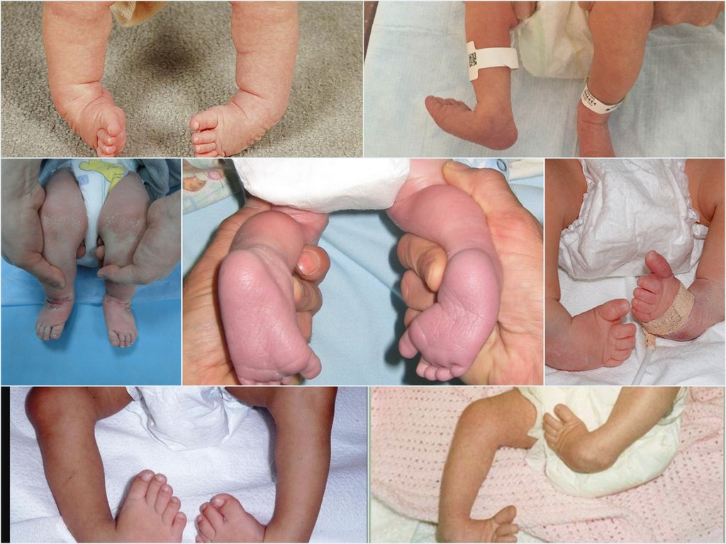 Виды врождённая детской косолапости